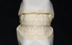 Esthetic Wax-up